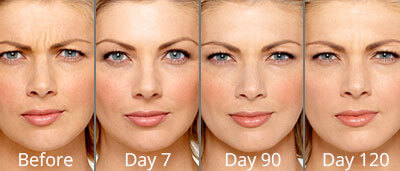 Before & After Botox Injections Chesapeake VA