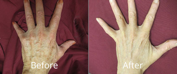 Before & After Photofacials Chesapeake VA