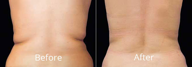 coolsculpting before after Chesapeake