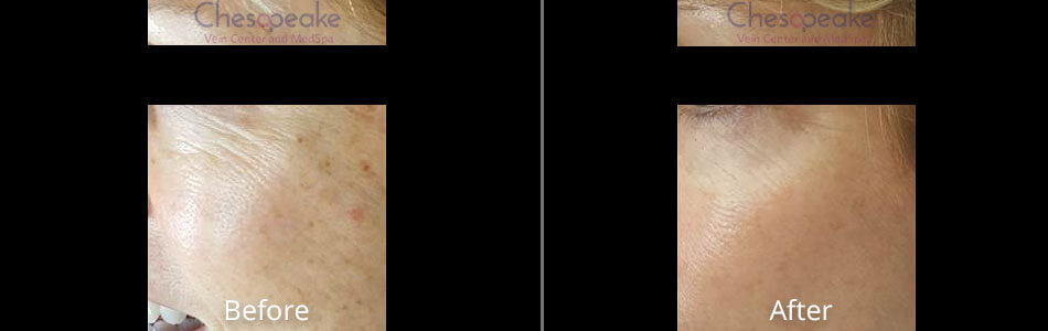 Before & After Halo Norfolk
