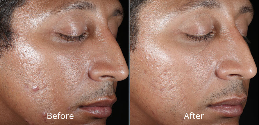 Before & After Chemical Peels Chesapeake VA