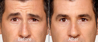 Before & After Botox Treatment Norfolk VA
