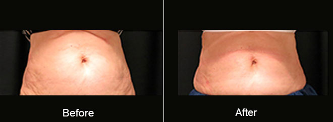 Before & After CoolSculpting Norfolk