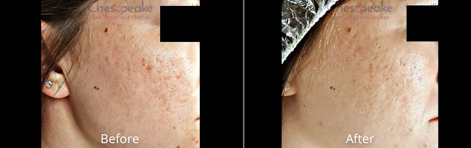 Before and After Microneedling Virginia Beach VA
