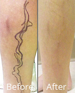 Before & After Varicose Vein Treatment Chesapeake