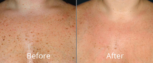 Before and After Photofacials Chesapeake VA