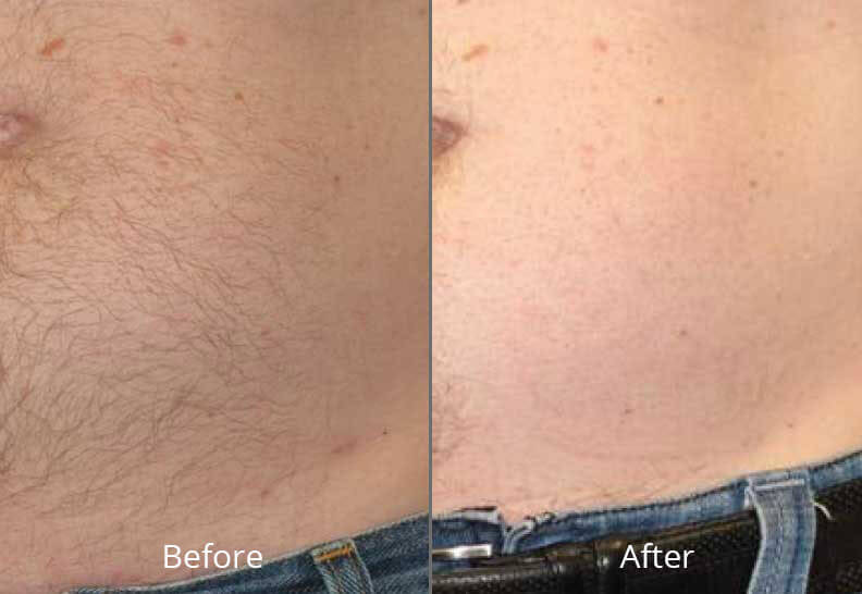 Before and After Hair Reduction Treatment Norfolk NA