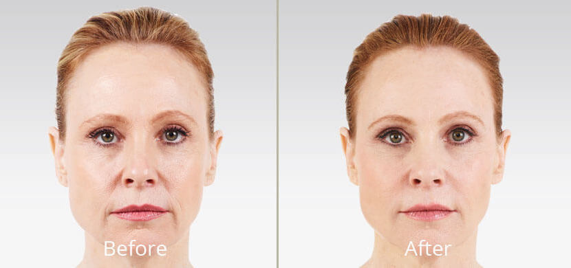 Before & After Dermal Fillers Chesapeake VA