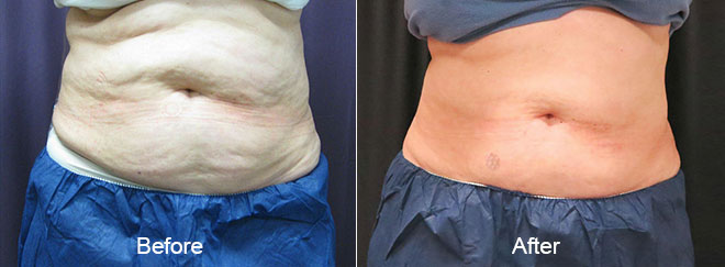 Before & After CoolSculpting Chesapeake