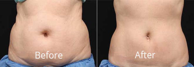 coolsculpting before after Norfolk
