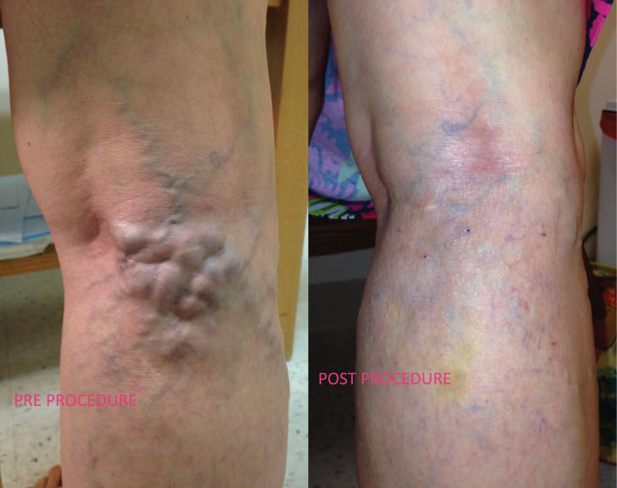 Before & After Microphlebectomy Norfolk
