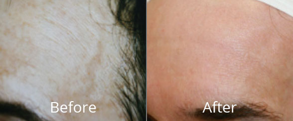 Before & After Photorejuvenation Norfolk VA