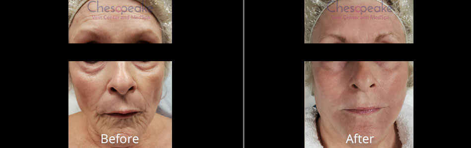 Before & After Skin Resurfacing Treatment Chesapeake VA
