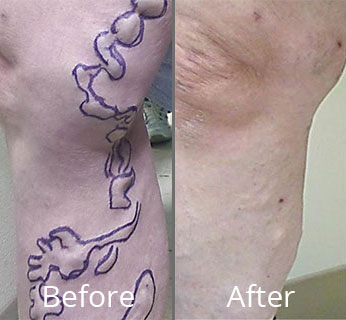 Before & After Varicose Vein Treatment Norfolk NA