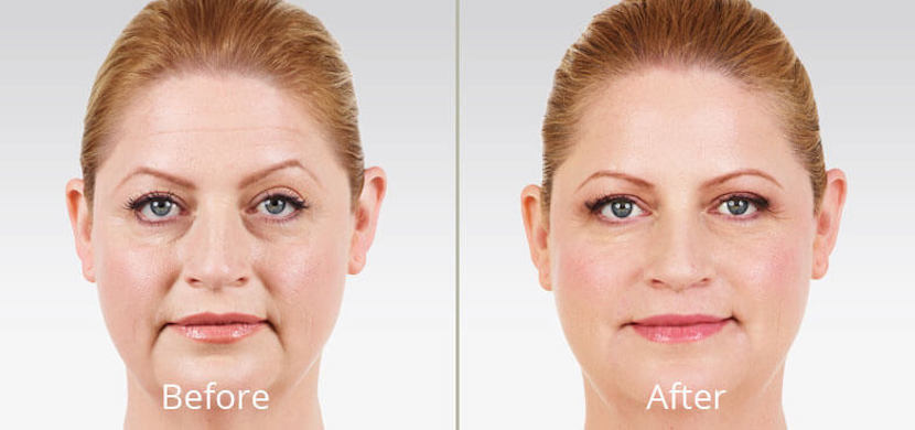 Before & After Dermal Fillers Norfolk VA