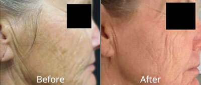 Before & After Skin Resurfacing Norfolk VA