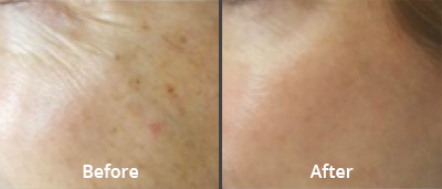 Before & After Halo Treatment Norfolk VA