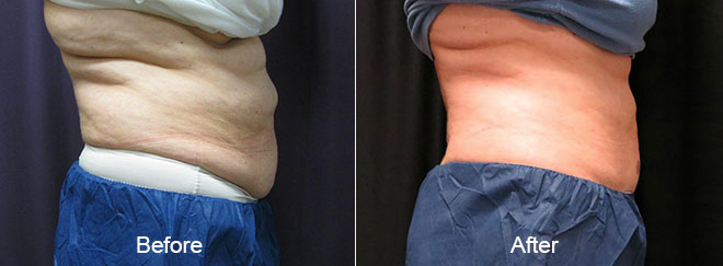 Before & After CoolSculpting Treatment Chesapeake