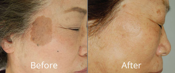 Before and After Photo rejuvenation Norfolk VA