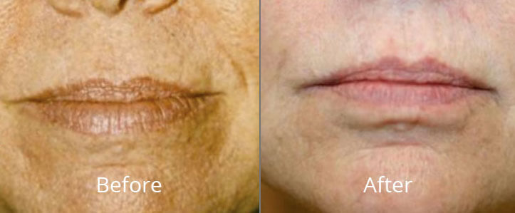 Before & After Photorejuvenation Chesapeake VA