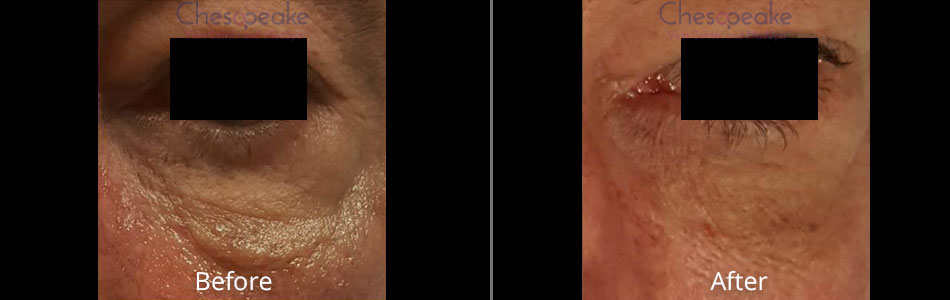Before & After Skin Resurfacing Treatment Norfolk