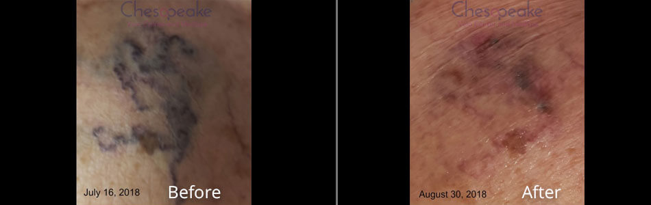 Before & After Sclerotherapy Chesapeake VA