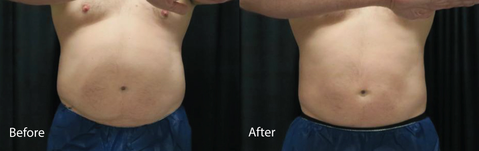 Before & After vein medspa coolsculpting Norfolk
