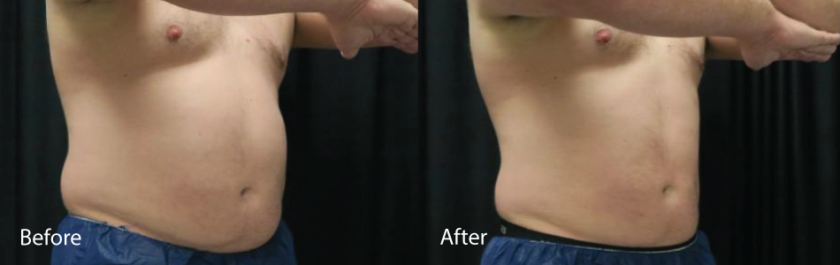 Before & After coolsculpting Chesapeake