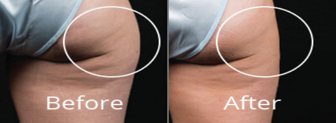 before after coolsculpting treatment Norfolk
