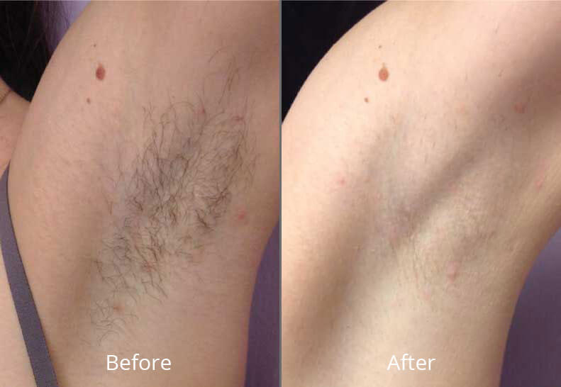Before & After Laser Hair Removal Chesapeake