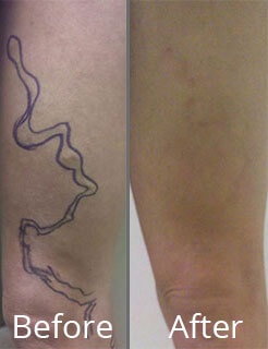 Before & After Vein Stripping Treatment Norfolk VA