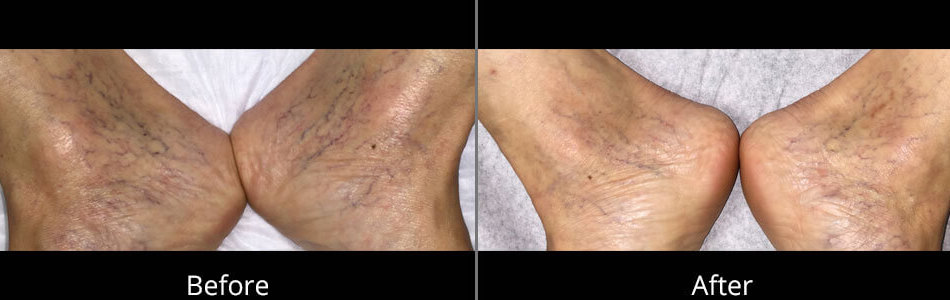 Before & After Spider Vein Removal Norfolk