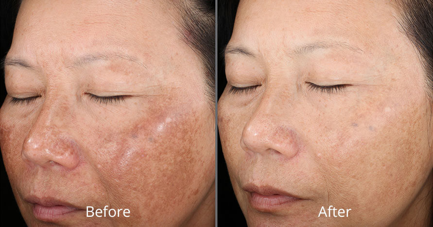 Before & After Dermapeeling Norfolk VA