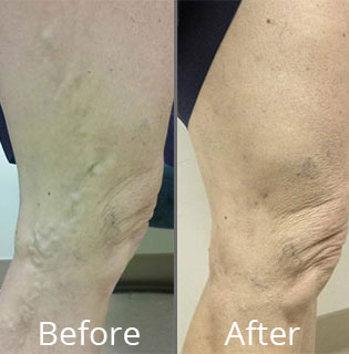 Before & After Vein Stripping Norfolk VA