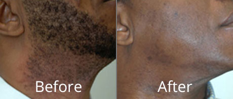 Before & After Laser Hair Removal Chesapeake