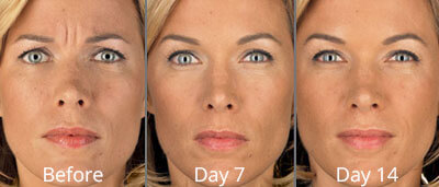 Before & After Botox Injections Norfolk VA