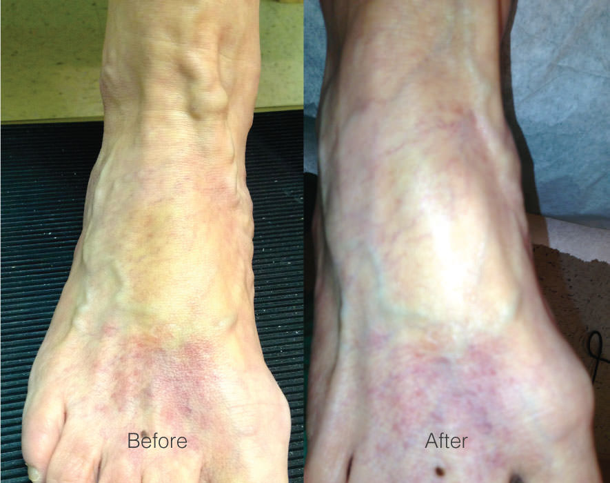 Before & After Ambulatory Phlebotomy Chesapeake