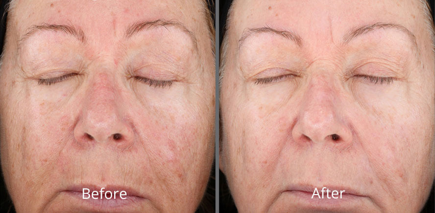 Before & After Dermapeeling Treatment Chesapeake VA