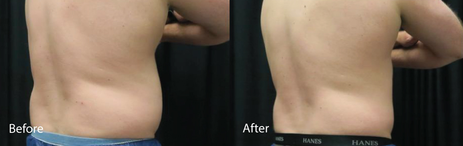 Before & After vein medspa coolsculpting Chesapeake