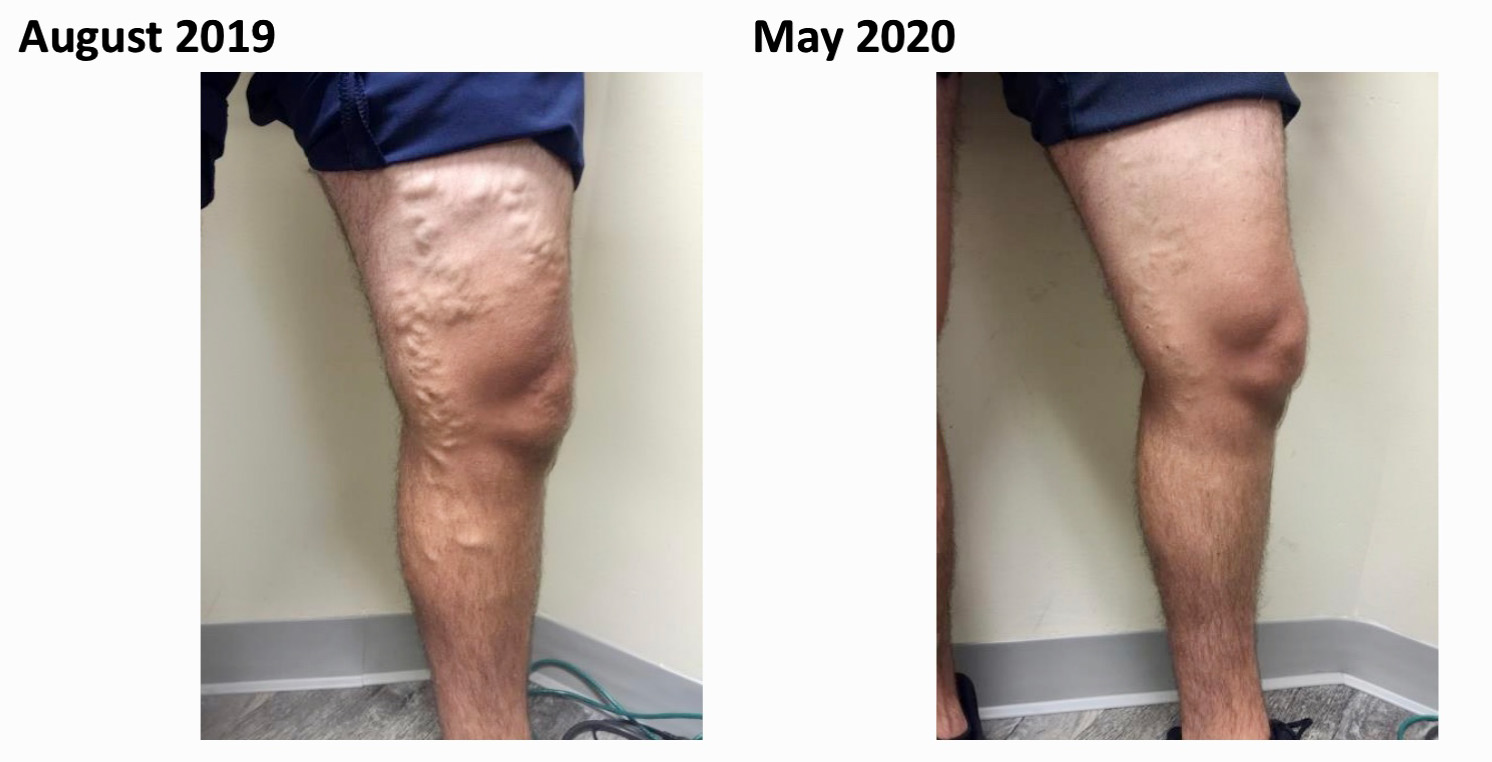 Varicose Vein Treatment in Chesapeake