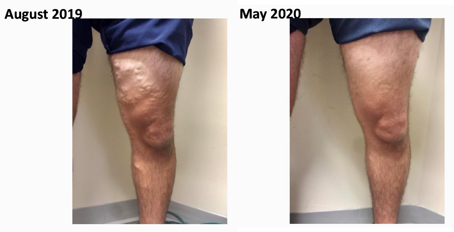 Varicose Vein Treatment in Chesapeake