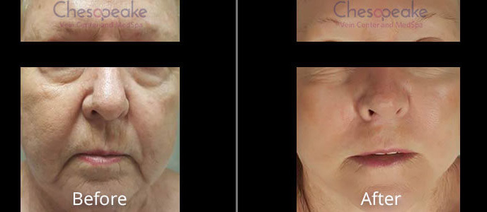 Halo Laser Skin Resurfacing in Chesapeake